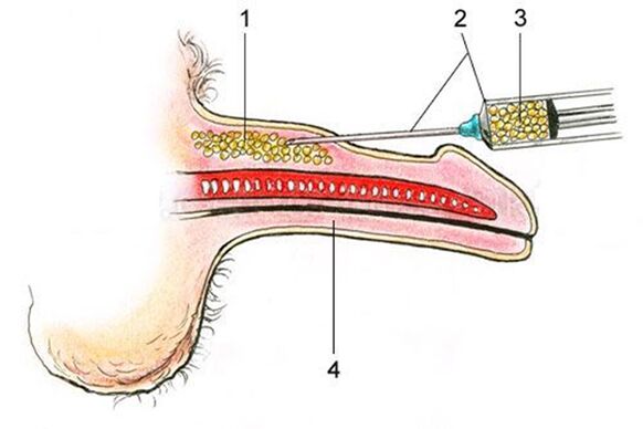 Lipofilling - a inserción de tecido graxo no eixe do pene
