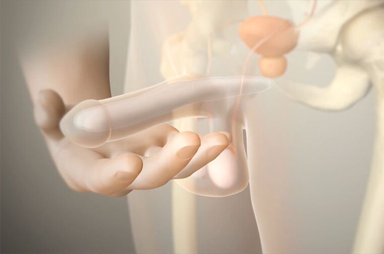 Implantes de xel para aumentar un membro