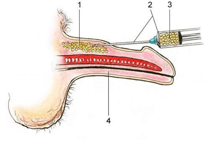 Lipofile para aumentar un membro