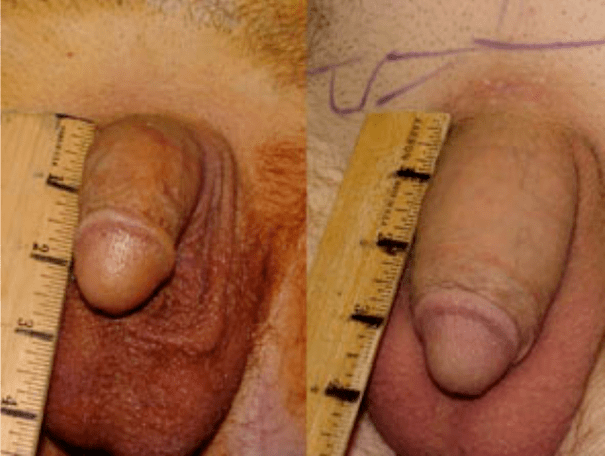 Antes e despois de lipofilling e implantación de gel