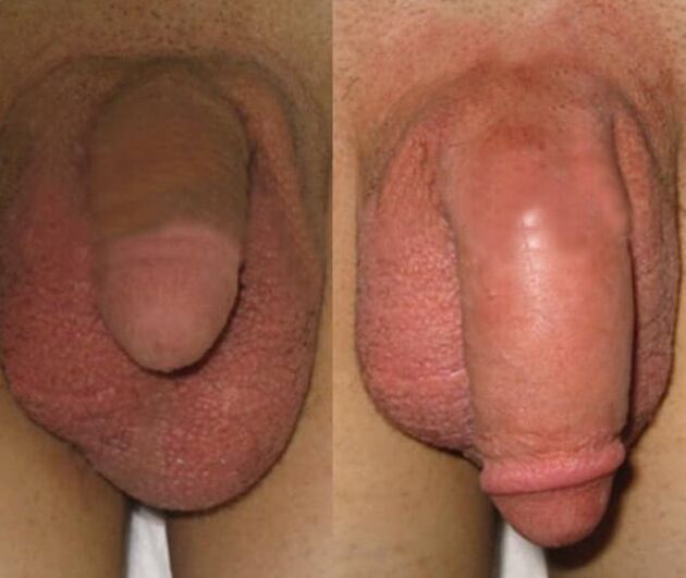 O resultado da instalación dunha matriz de coláxeno no pene